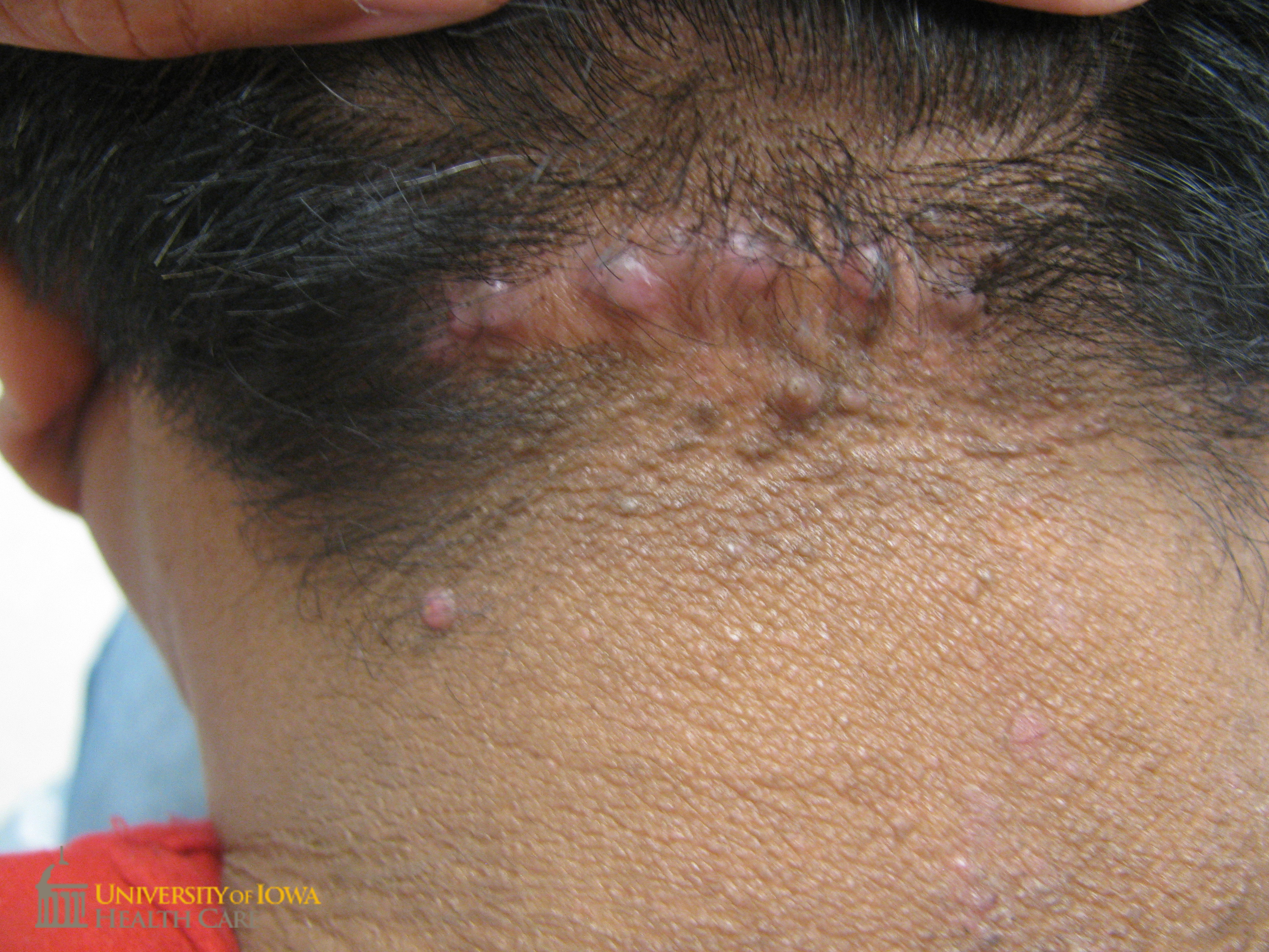 pink keloidal papules coalescing into a plaque on the occipital scalp. (click images for higher resolution).